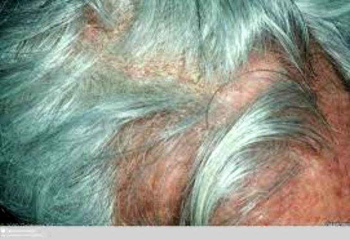 Hoofdhuid Biopsieën. Alles Wat U Moet Weten Over Haarverlies